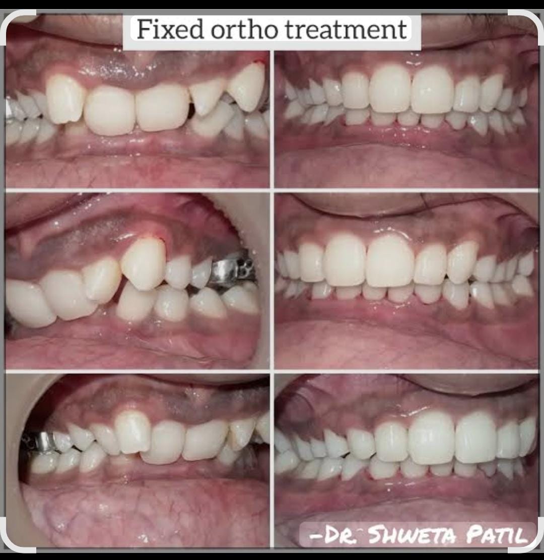 Before and after clinical photographs of crowded teeth aligned with fixed orthodontic braces treatment