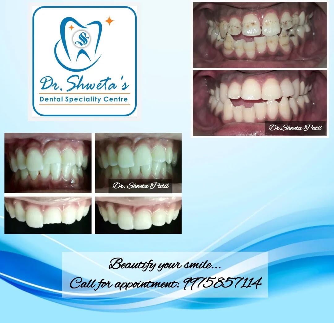 Before and after clinical photographs of a smile restored with crowns at the clinic