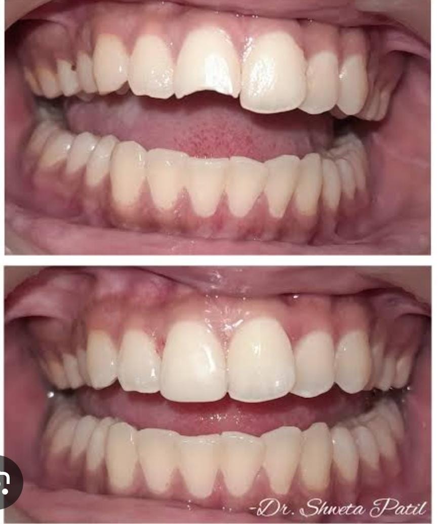 Before and after clinical photographs of a chipped front tooth repaired with tooth-coloured restoration